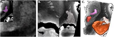 MRI Atlas of the Human Deep Brain